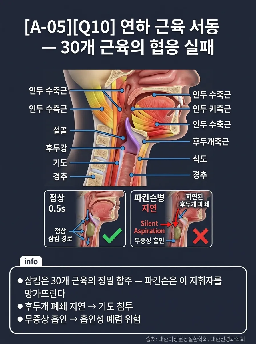 연하 근육 서동 — 30개 근육의 협응 실패