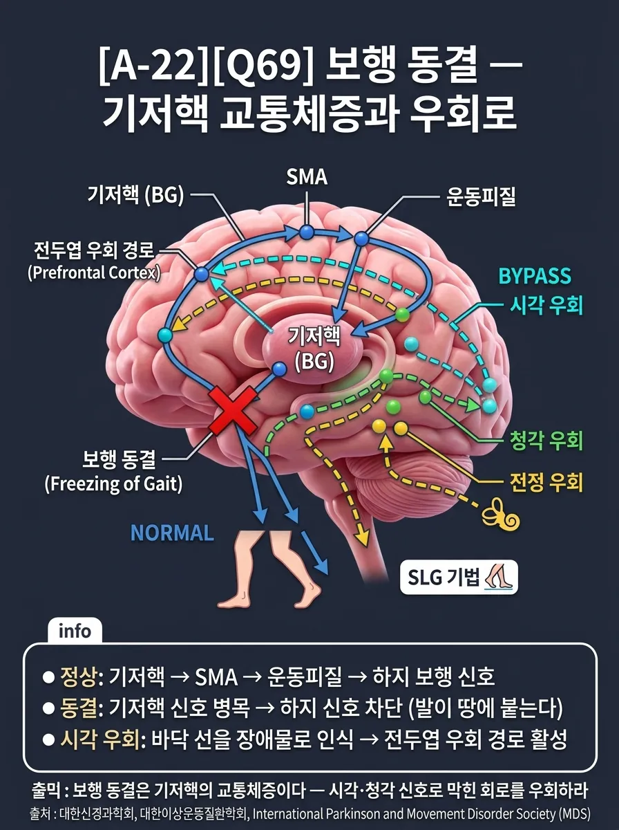 보행 동결 — 기저핵 교통체증과 우회로