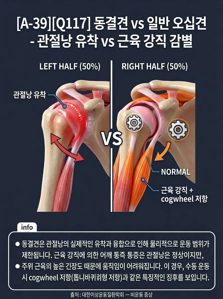 동결견 vs 오십견 — 관절낭 유착 vs 근육 강직 감별