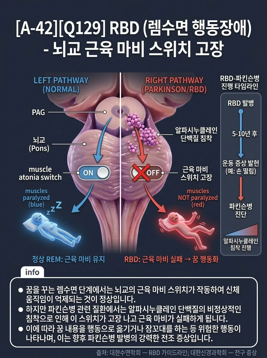 RBD(렘수면 행동장애) — 뇌교 근육 마비 스위치 고장
