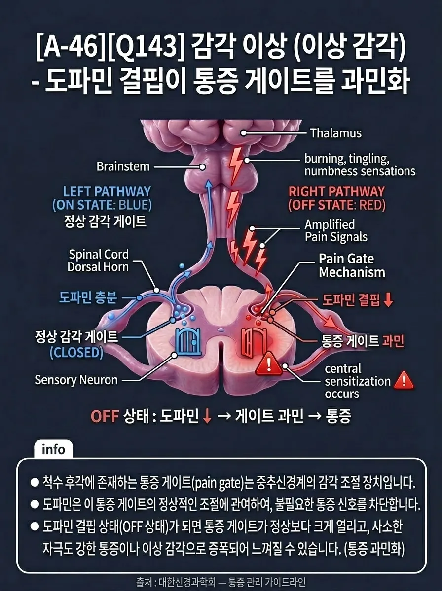 감각 이상 — 도파민 결핍이 통증 게이트를 과민화