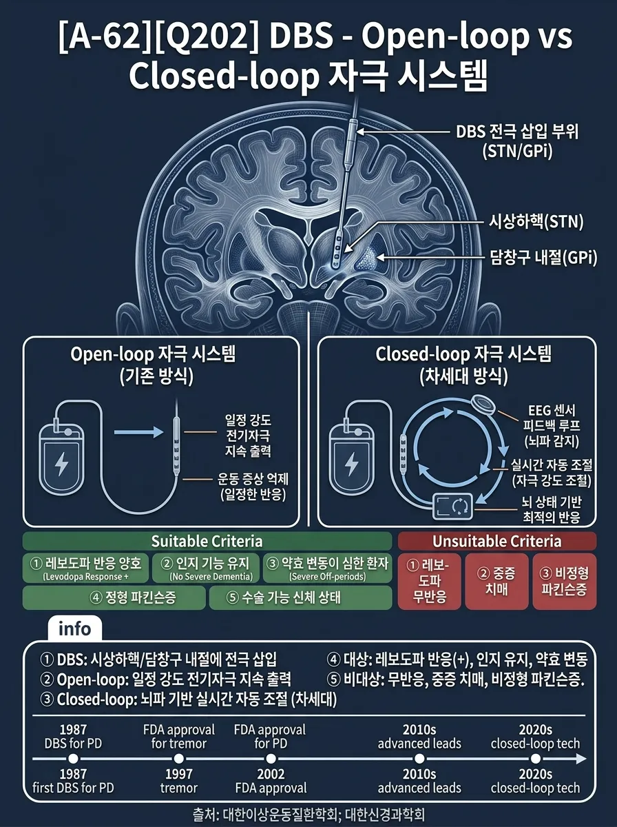 DBS — Open-loop vs Closed-loop 자극 시스템