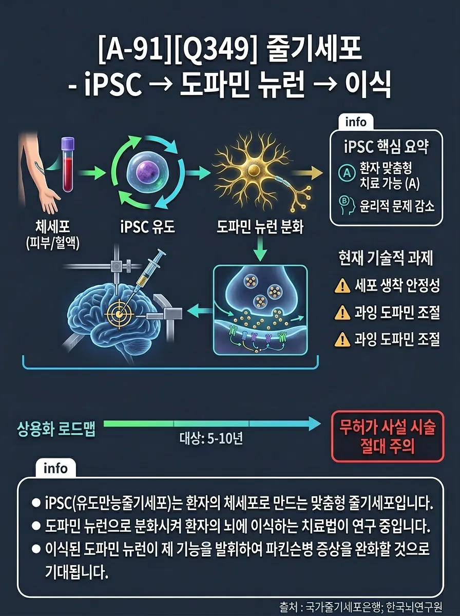 줄기세포 — iPSC → 도파민 뉴런 → 이식