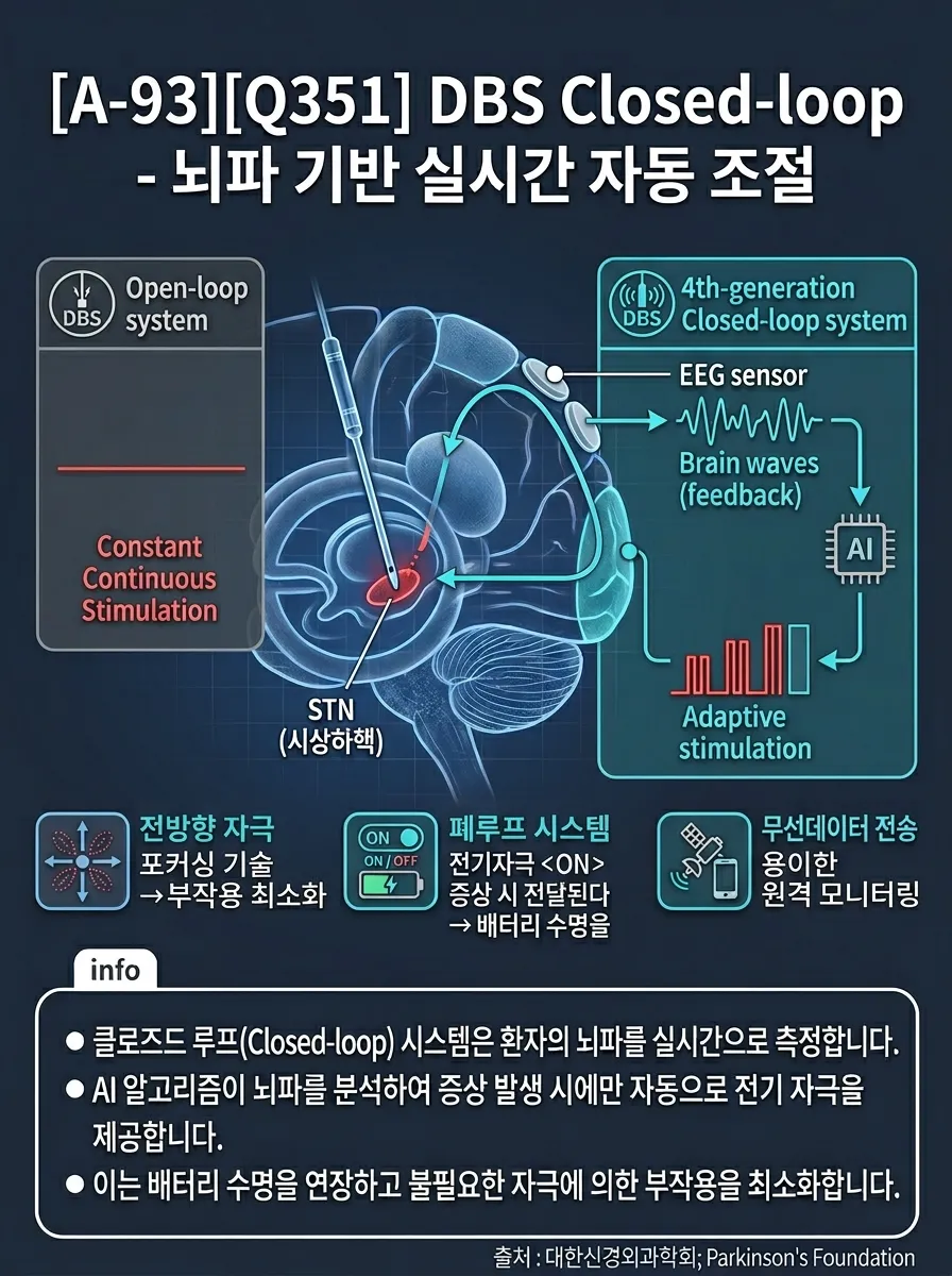 DBS Closed-loop — 뇌파 기반 실시간 자동 조절